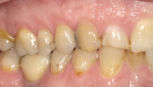 Close-up van tanden en kiezen met tandheelkundige behandeling.