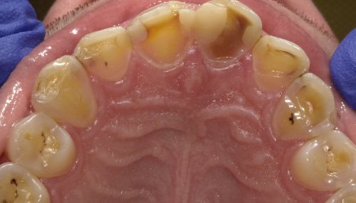 Mond met tanden en kiezen, tandheelkundige behandeling in Wiebinga.
